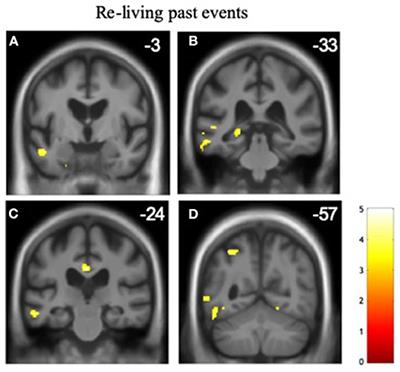 Altered Time Awareness in Dementia